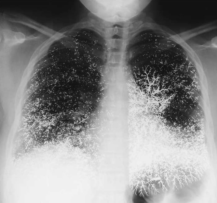 Someone attempted suicide by injecting 10 ml (135 g) of elemental mercury (quicksilver) intravenously ended up mercury distributed in the lungs and also survived.