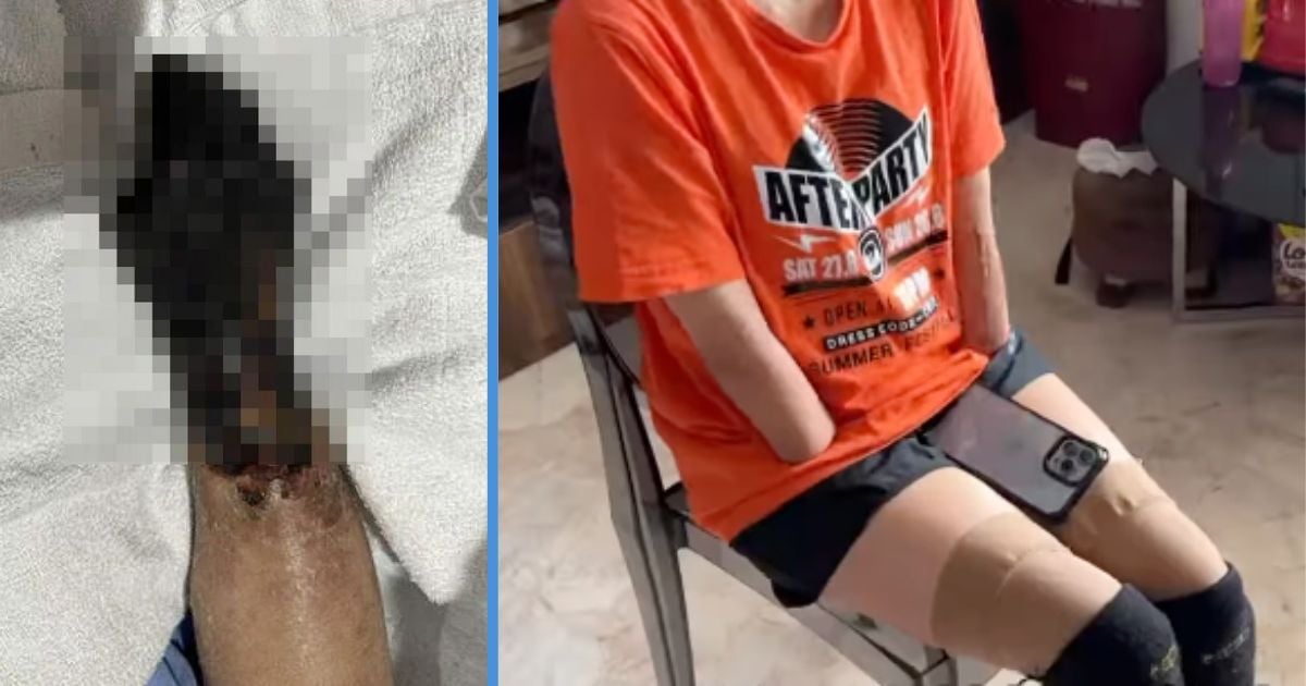 37Y0 M’sian Working in S’pore Had to Amputate 4 Limbs Due to Bacterial Infection