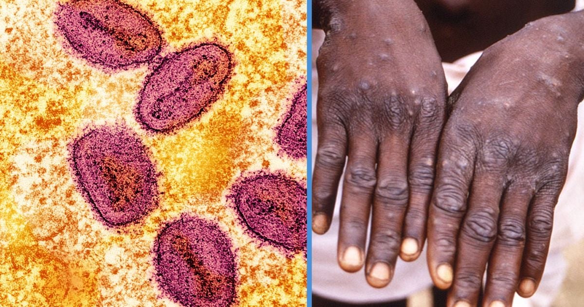 WHO Has Now Declared MPox As a Global Public Health Emergency Again