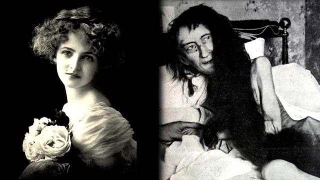 Photographs of Blanche Monnier before and after being locked inside a filthy room for 25 years by her cruel mother.