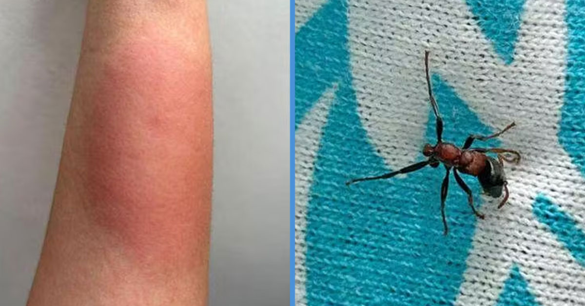 Man Bitten By “Deadliest” Ant Species While in Bus; Took 4 Days to Recover