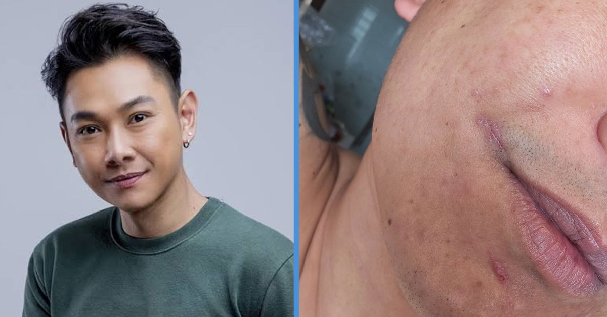 Actor Ryan Lian Shares Images of Scars from His Wounds, Receives Encouragement from Friends